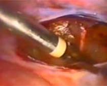 Retrait de la vidéo de l'utérus à l'aide du laparoscope (hystérectomie laparoscopique)
