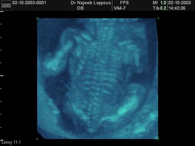 3D Photos échographie du squelette du fœtus